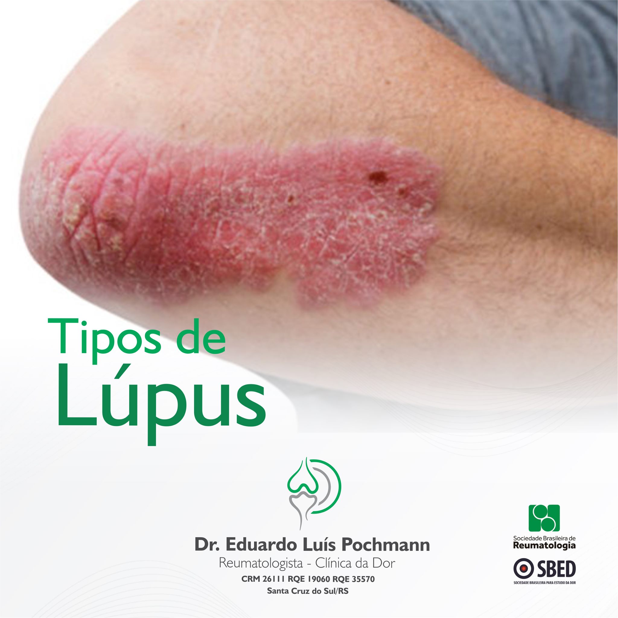 Tipos de Lúpus - Case MKT - Marketing Santa Cruz do Sul