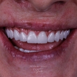 Studio do Dente - Prótese Protocolo - um sorriso completo e confiante para você